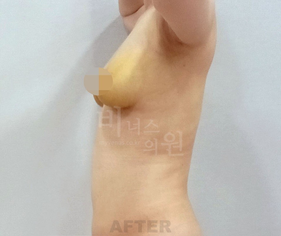 가슴축소 지방흡입 수술 후 사례 2 비너스의원