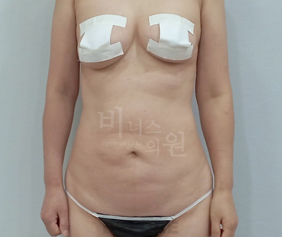 원통형 흉복부 지방흡입 재수술 전 사례 1 비너스의원