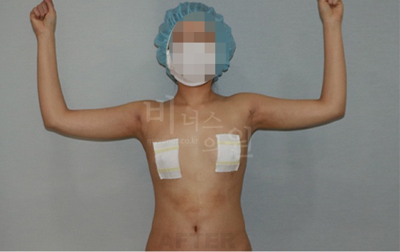 팔뚝지방흡입 수술 후 측면