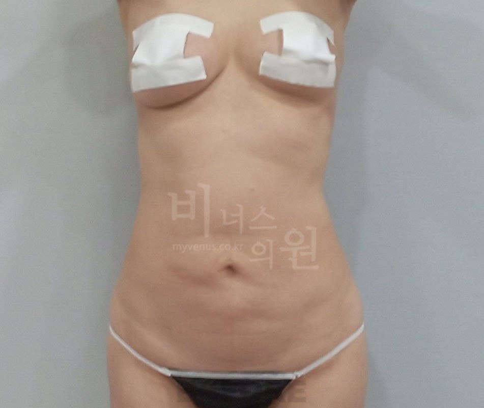 원통형 흉복부 지방흡입 재수술 전 사례 2 비너스의원