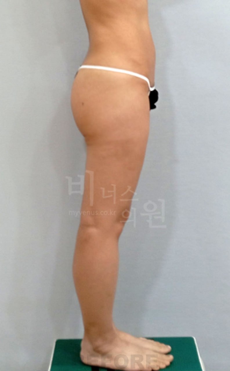 엉덩이 지방흡입 수술 전 측면 비너스의원