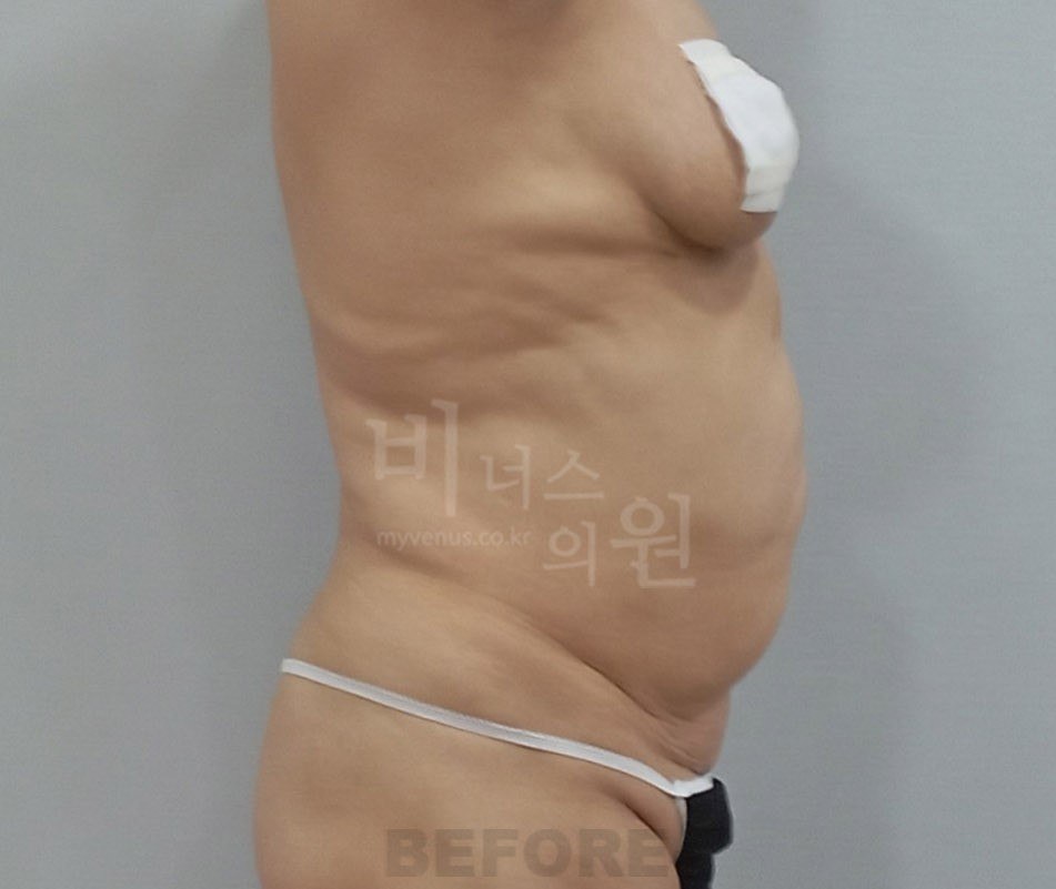 원통형 흉복부 지방흡입 수술 전 측면 (케이스2) 비너스의원