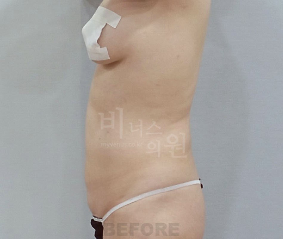 복부 지방흡입 수술 전 사례 2 비너스의원