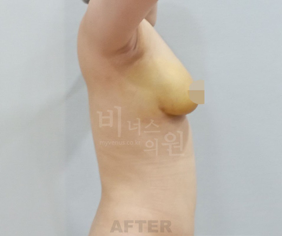 가슴축소 지방흡입 수술 후 사례 3 비너스의원