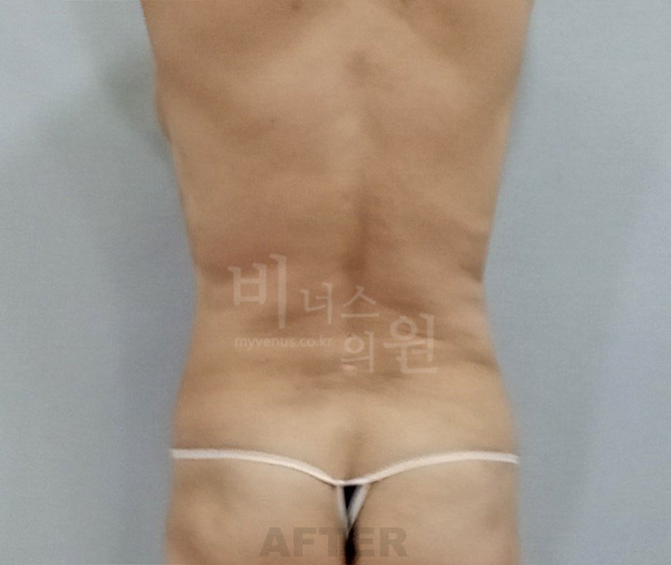 원통형 흉복부 지방흡입 수술 후 후면 비너스의원