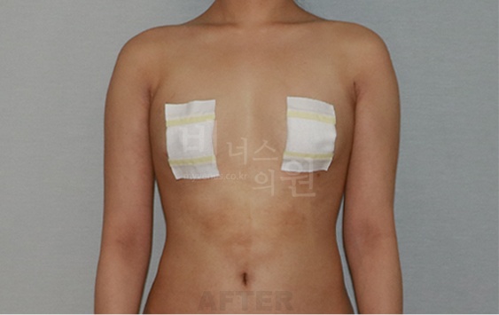 팔뚝지방흡입 수술 후 정면