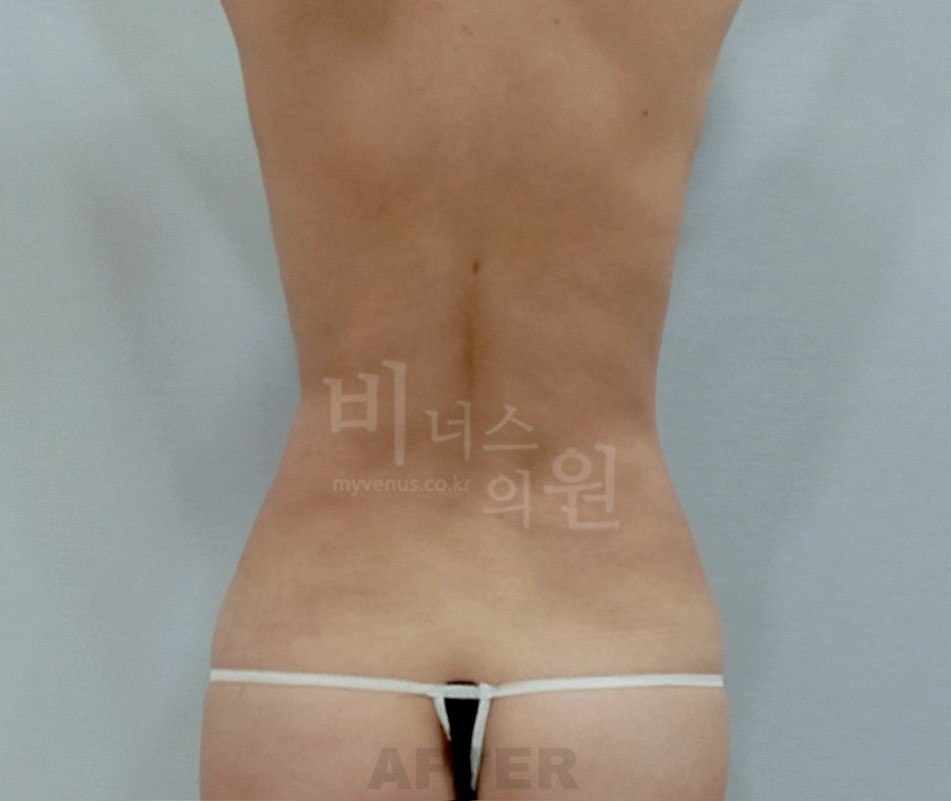 원통형 흉복부 지방흡입 재수술 후 사례 4 비너스의원