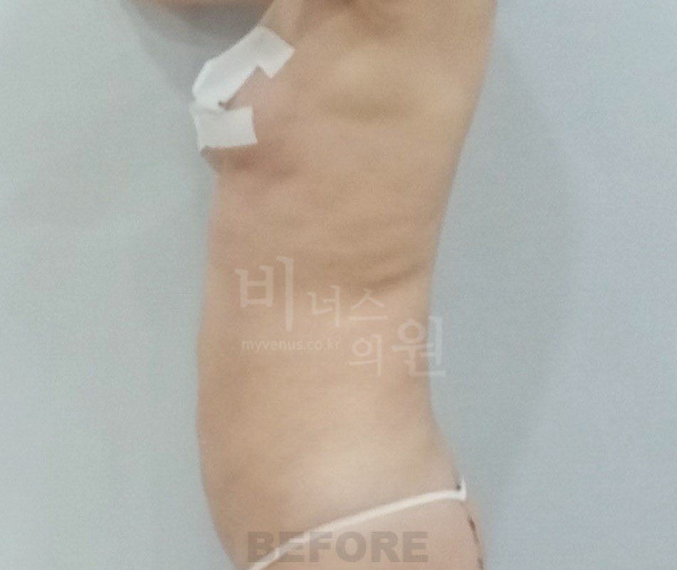 원통형 흉복부 지방흡입 재수술 전 사례 3 비너스의원