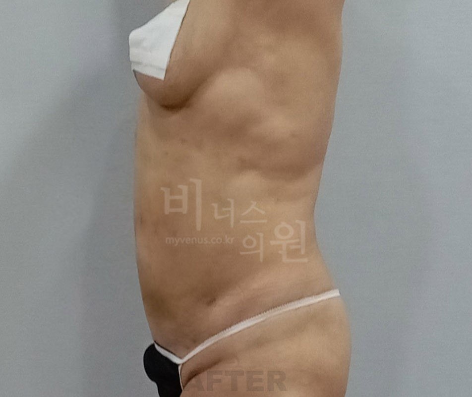원통형 흉복부 지방흡입 수술 후 측면 비너스의원