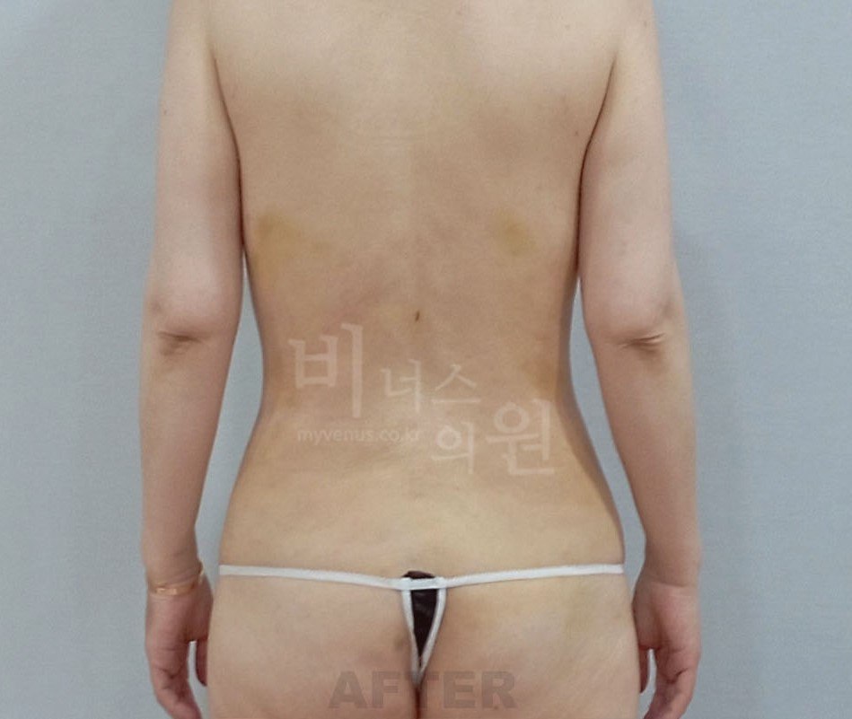 복부 지방흡입 수술 후 사례 3 비너스의원