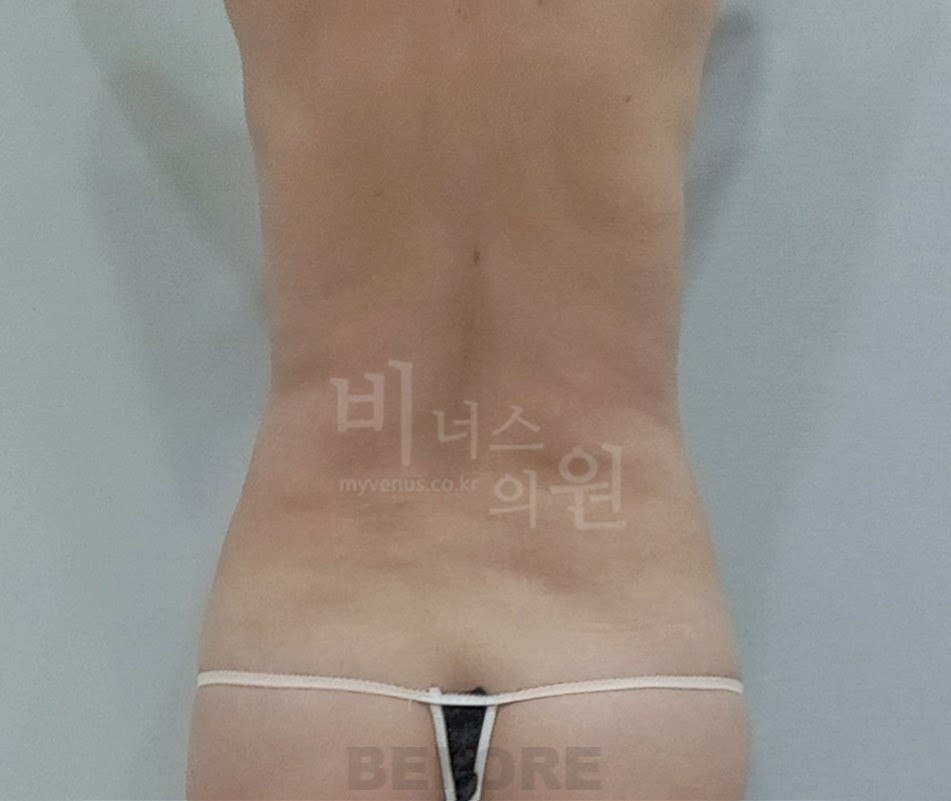 원통형 흉복부 지방흡입 재수술 전 사례 4 비너스의원