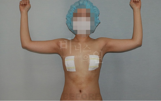 팔뚝지방흡입 수술 전 측면