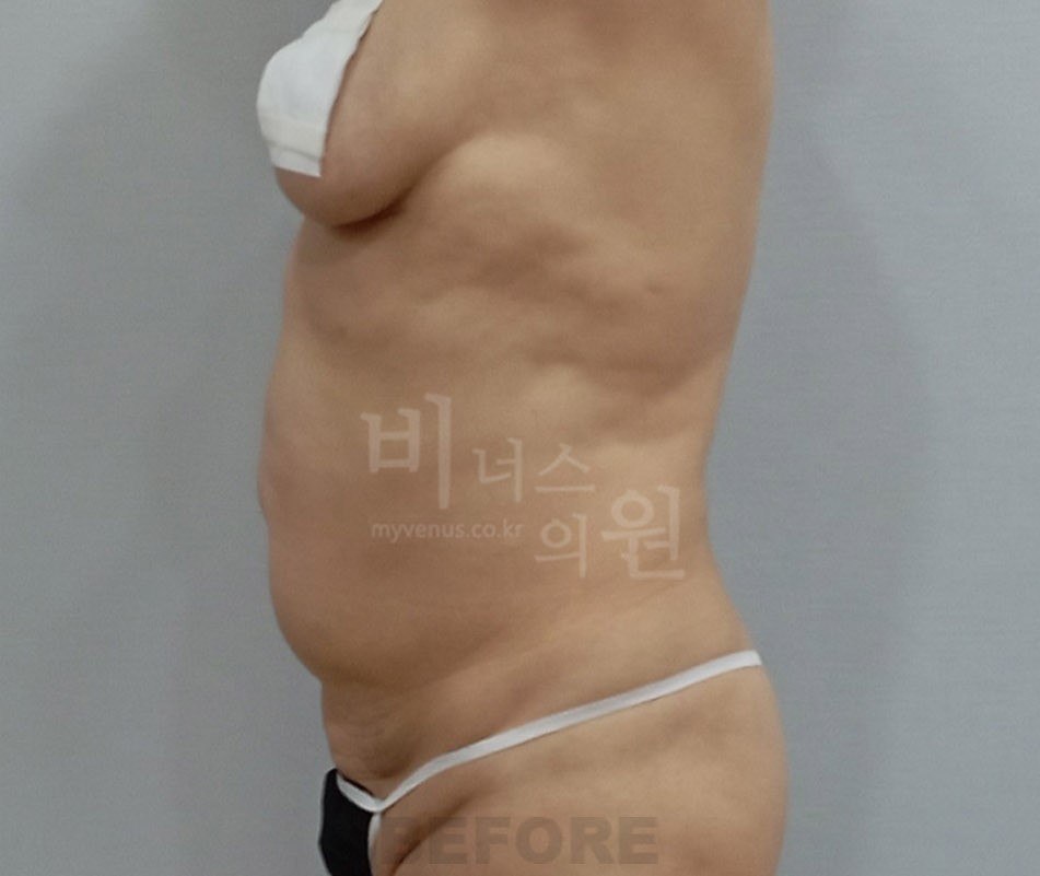 원통형 흉복부 지방흡입 수술 전 측면 비너스의원