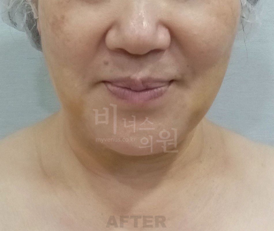 이중턱·턱 지방흡입 수술 후 정면 비너스의원