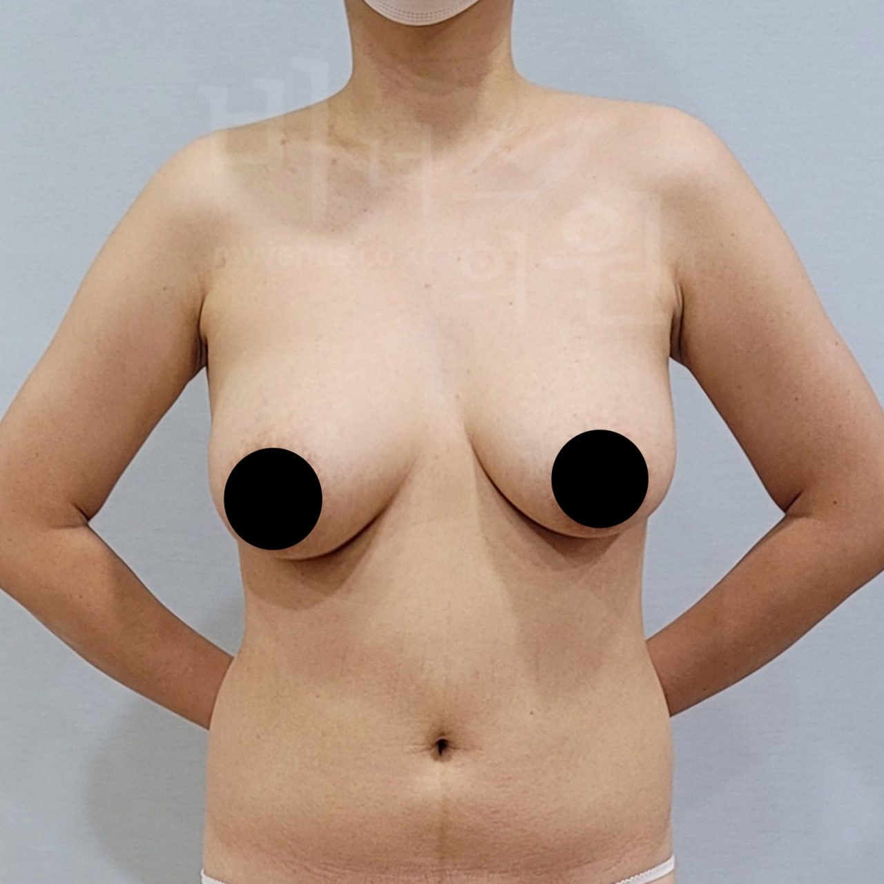가슴축소 지방흡입 수술 전 정면 비너스의원