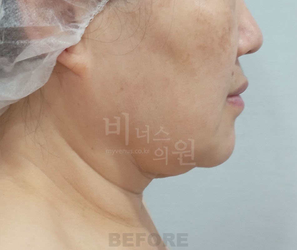 이중턱·턱 지방흡입 수술 전 사면 비너스의원