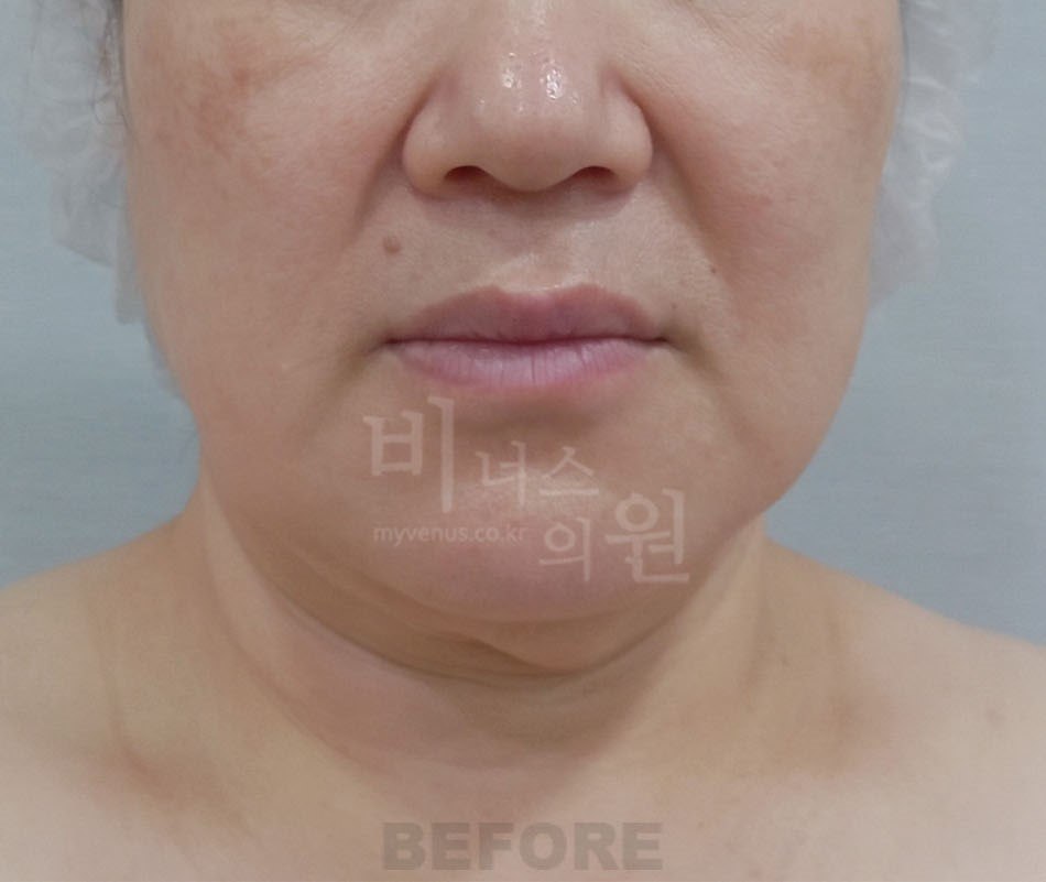 이중턱·턱 지방흡입 수술 전 정면 비너스의원