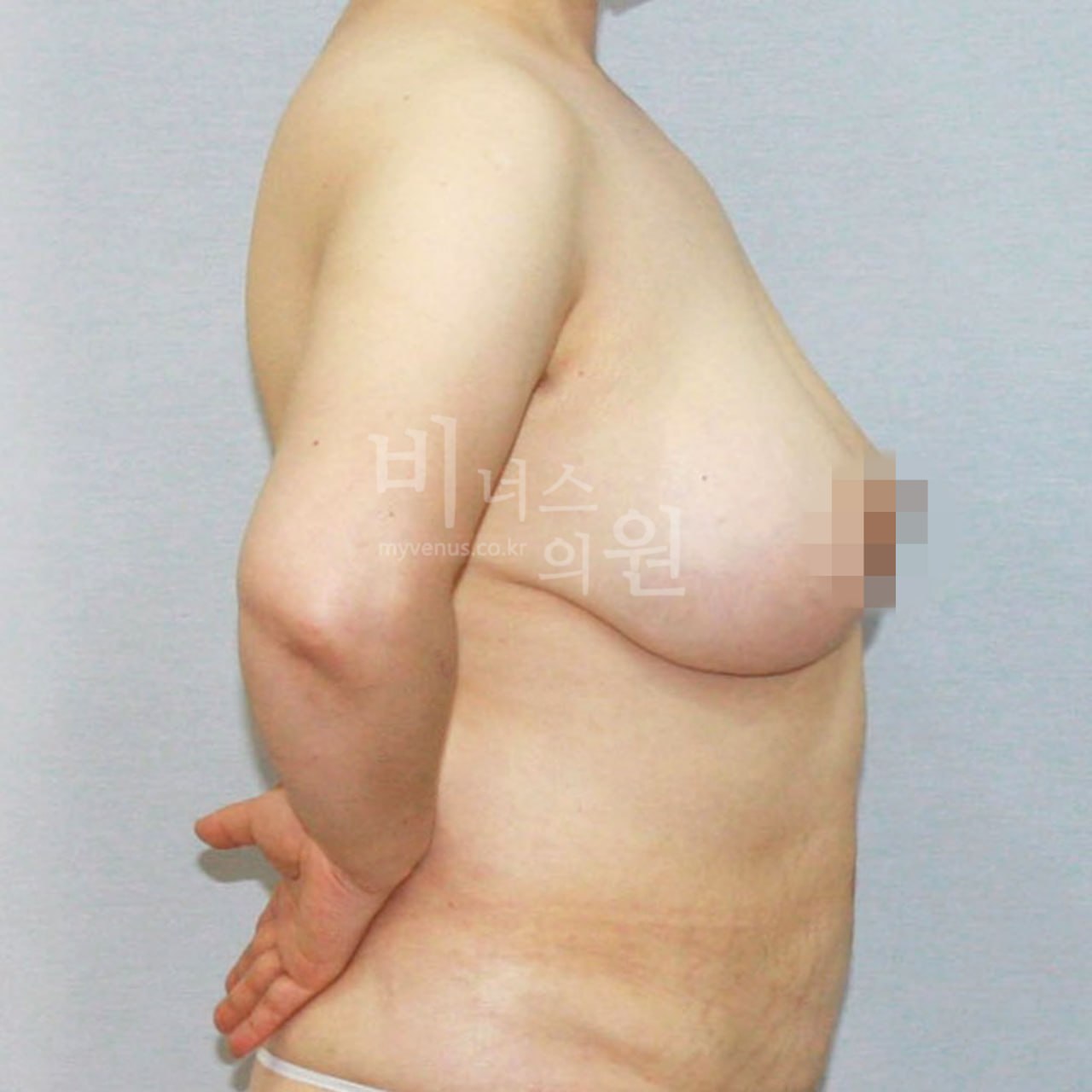 가슴축소 지방흡입 수술 전 왼측 비너스의원