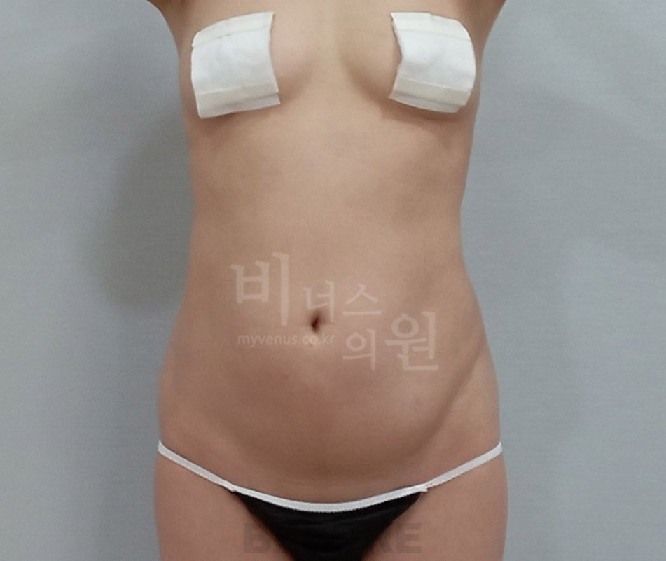 복부 지방흡입 수술 전 정면 비너스의원