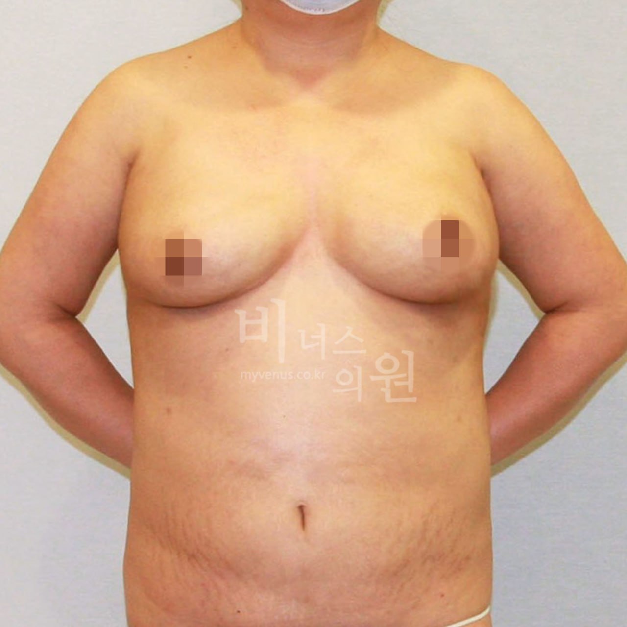 유방축소 수술 후 정면