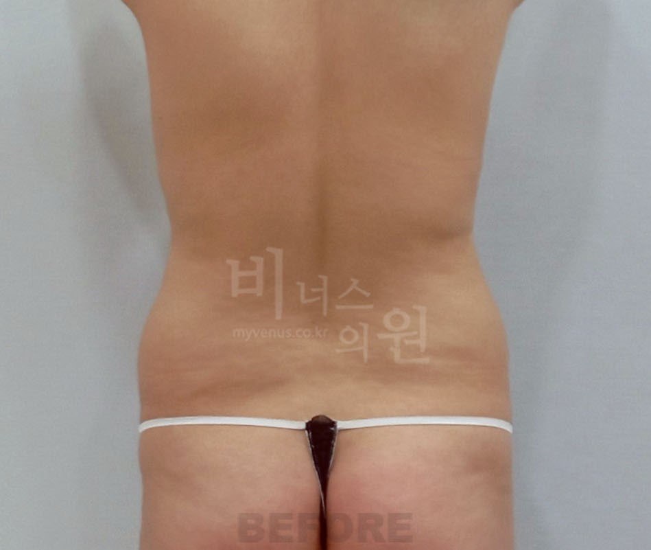 복부 지방흡입 수술 전 사례 3 비너스의원