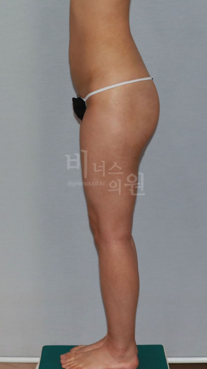 복부 엉덩이 동시 지방흡입 수술 후 측면 비너스의원