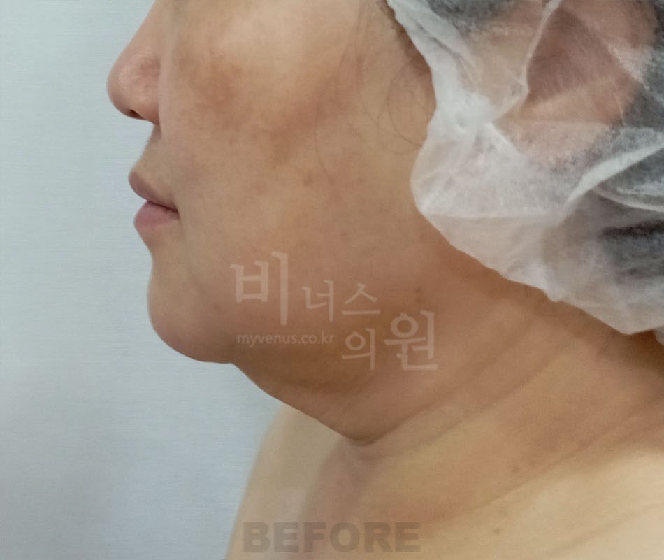 이중턱·턱 지방흡입 수술 전 측면 비너스의원