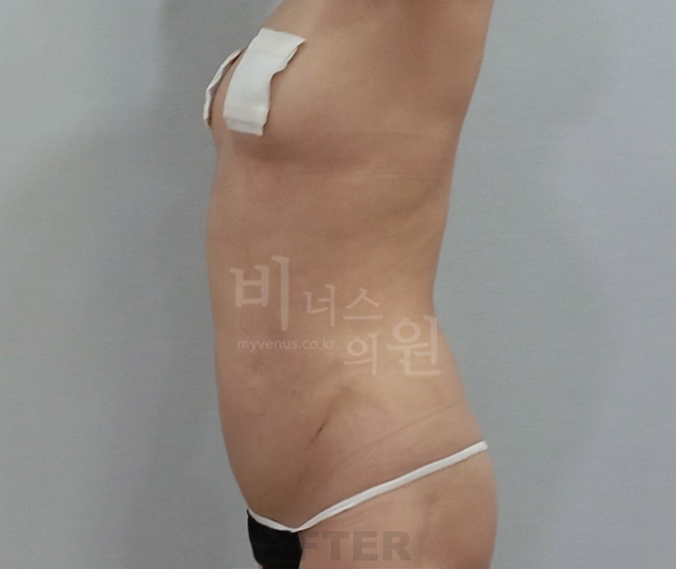 복부 지방흡입 수술 후 측면 비너스의원