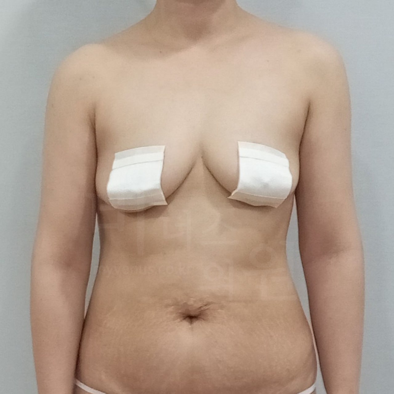 팔뚝 지방흡입 수술 후 정면 비너스의원