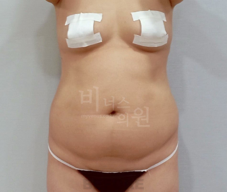 복부 지방흡입 수술 전 사례 1 비너스의원
