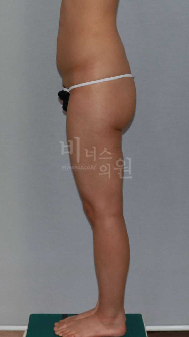 복부 엉덩이 동시 지방흡입 수술 전 측면 비너스의원