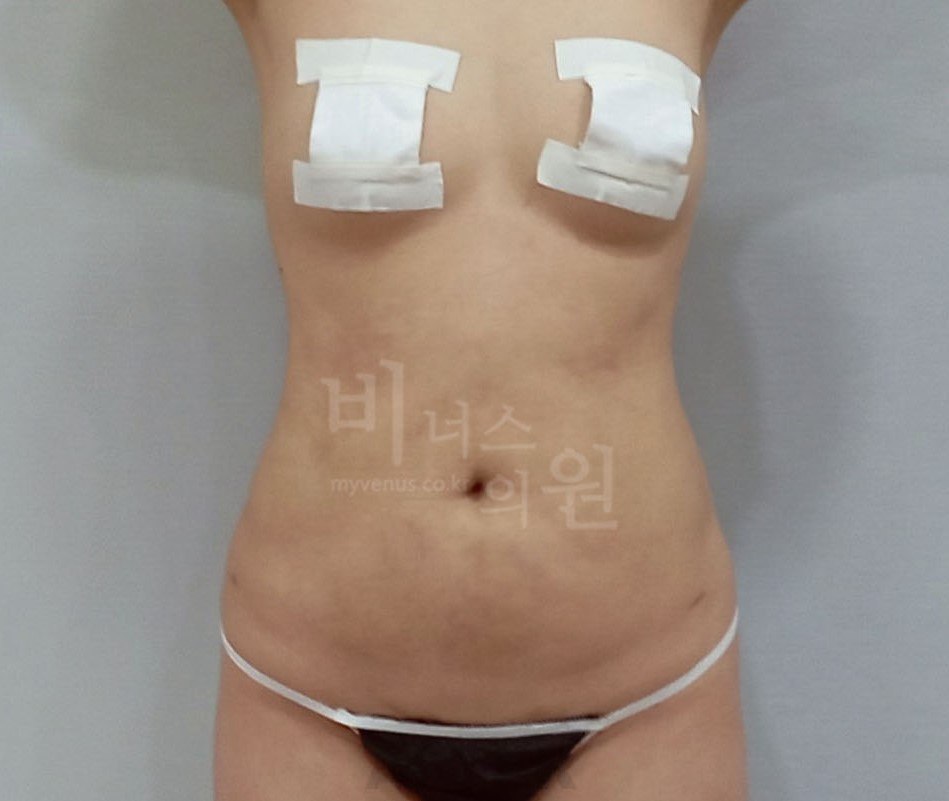 복부 지방흡입 수술 후 사례 1 비너스의원