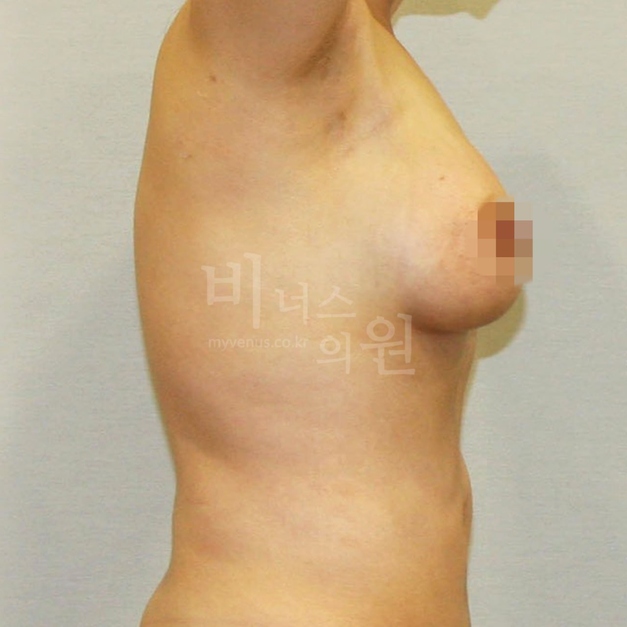 가슴 축소 지방흡입 수술 후 측면 비너스의원