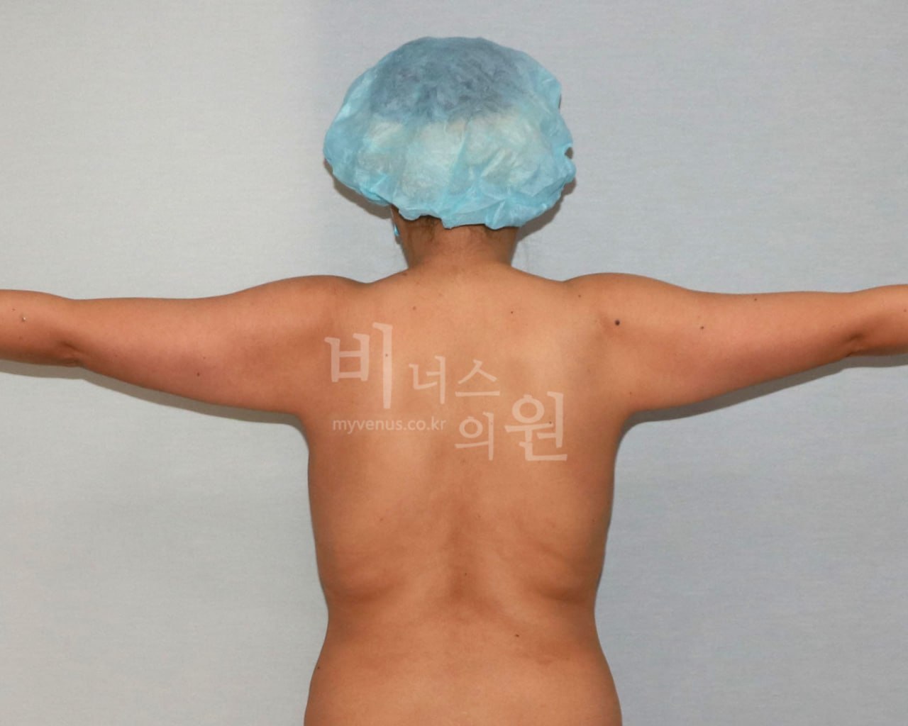 팔뚝 지방흡입 수술 전 비너스의원 CASE 3