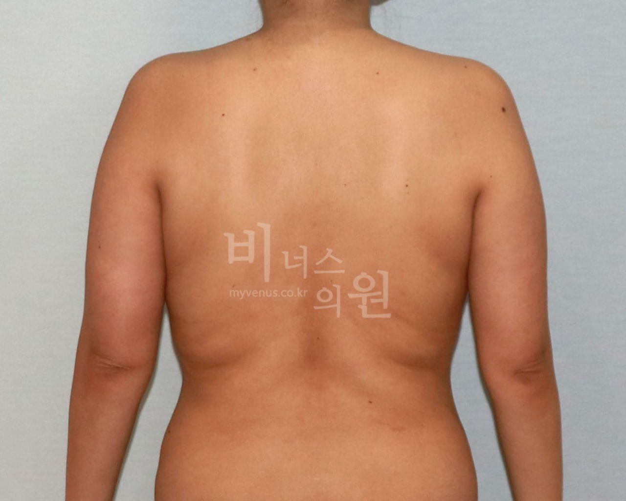 팔뚝 지방흡입 수술 전 비너스의원 CASE 2