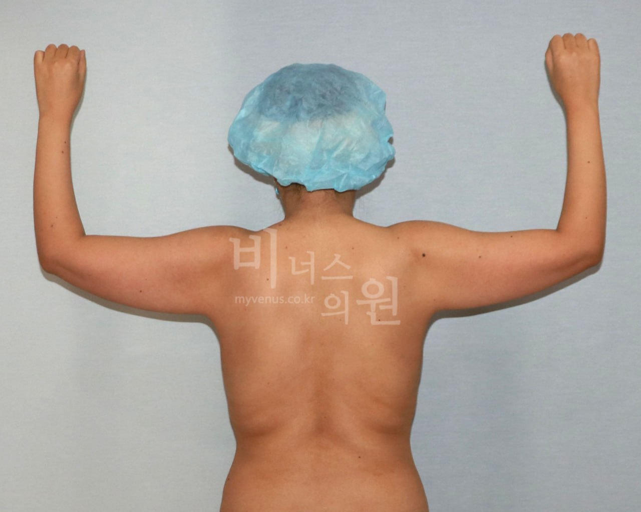 팔뚝 지방흡입 수술 전 비너스의원 CASE 1