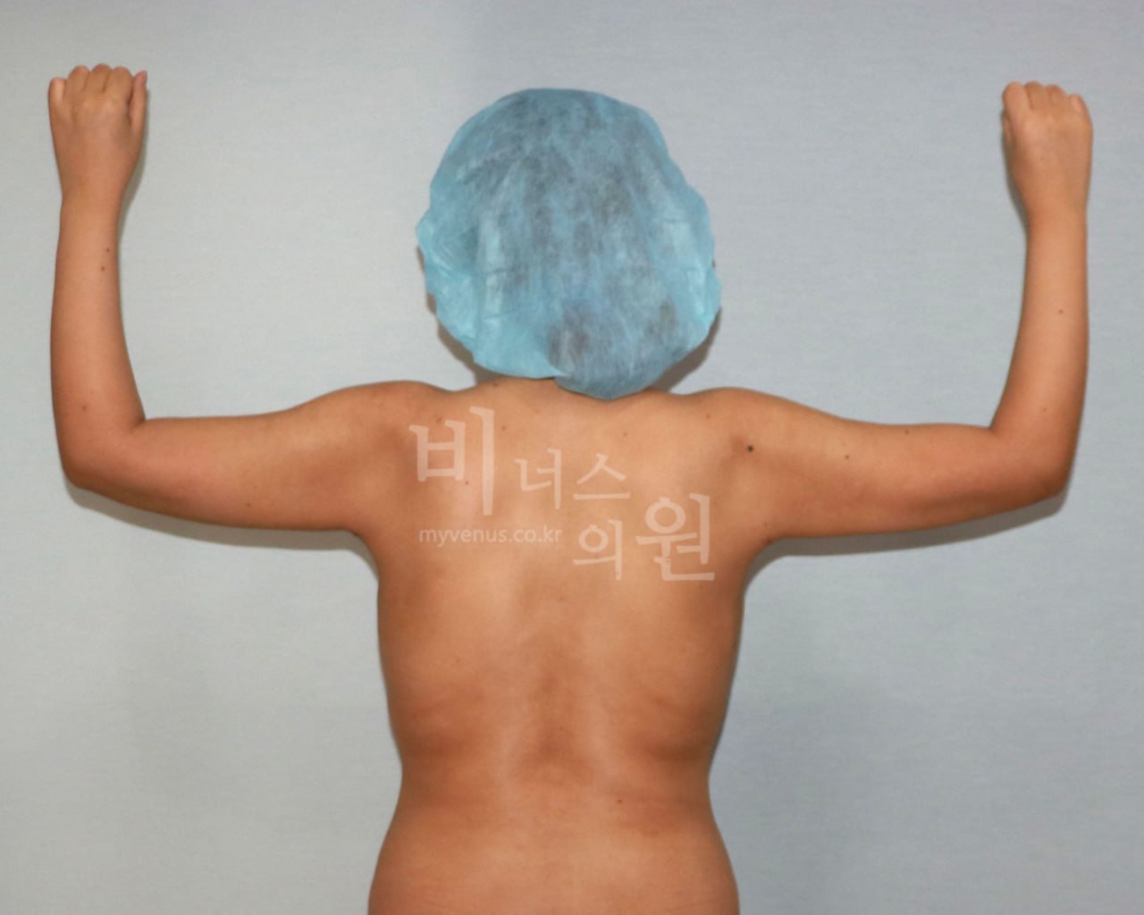 팔뚝 지방흡입 수술 후 비너스의원 CASE 1