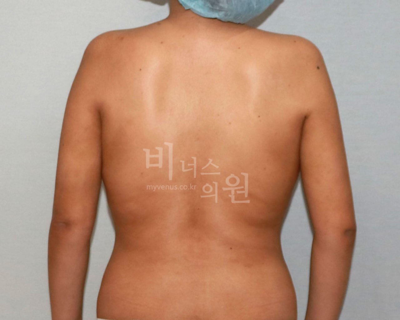 팔뚝 지방흡입 수술 후 비너스의원 CASE 2