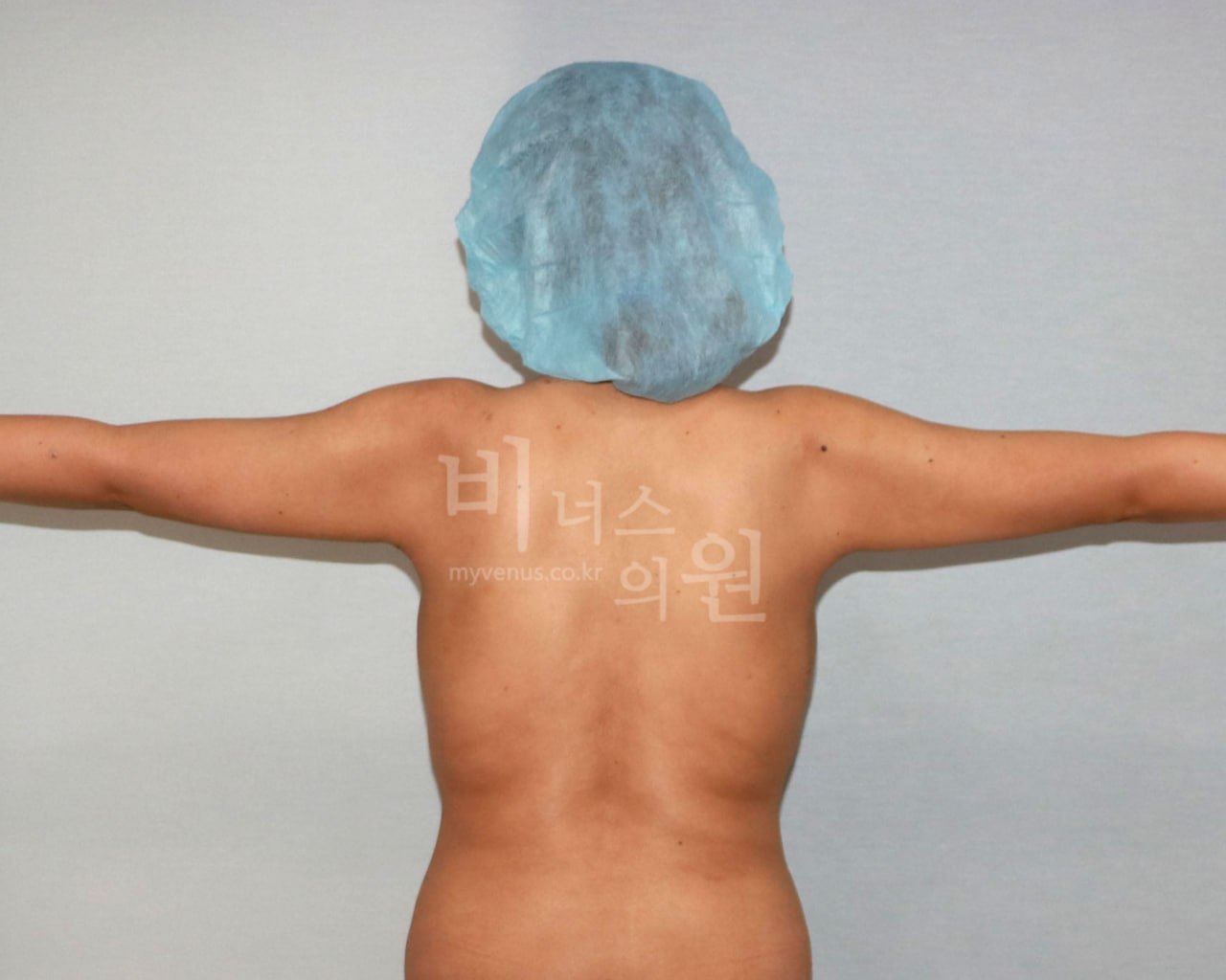 팔뚝 지방흡입 수술 후 비너스의원 CASE 3