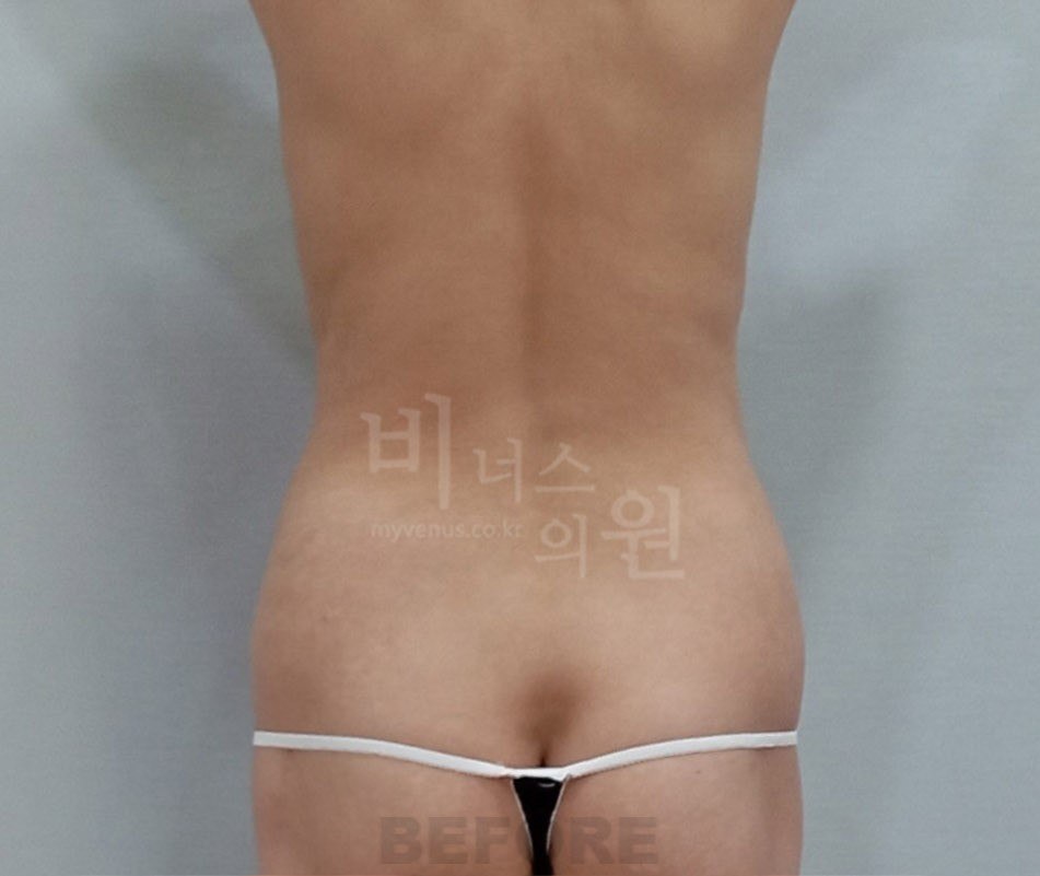 복부 지방흡입 수술 전 후면 비너스의원