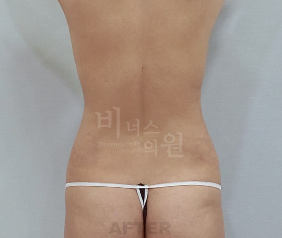 복부 지방흡입 수술 후 사례 3 비너스의원