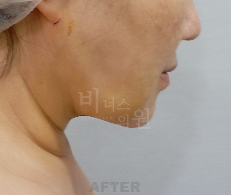 이중턱·턱 지방흡입 수술 후 사면 비너스의원