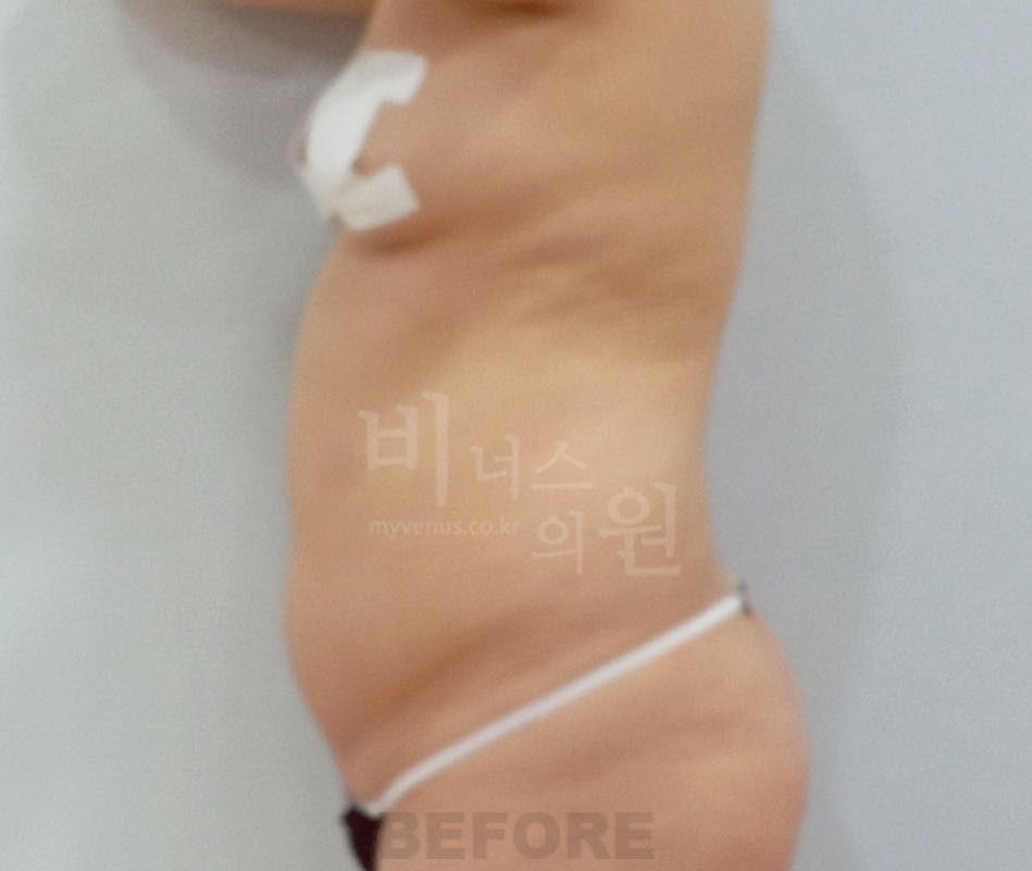 복부 지방흡입 수술 전 사례 2 비너스의원