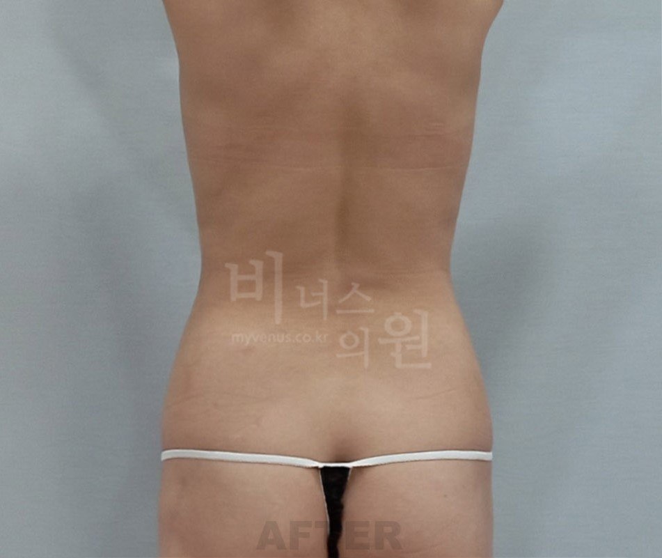복부 지방흡입 수술 후 후면 비너스의원