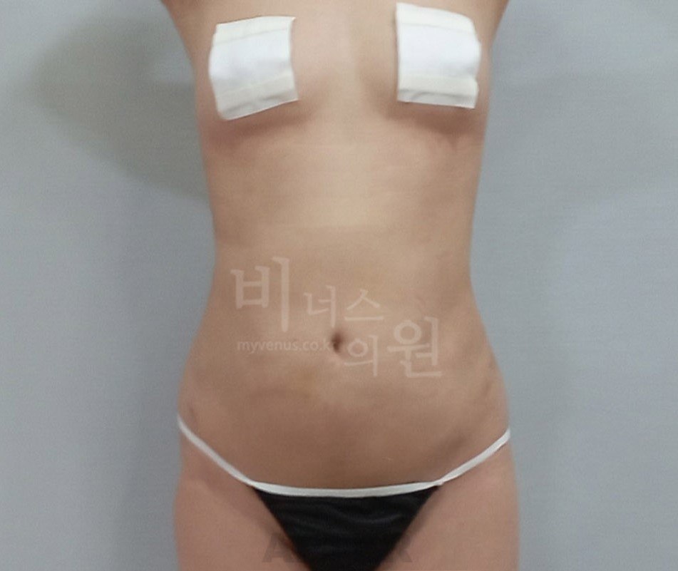 복부 지방흡입 수술 후 정면 비너스의원