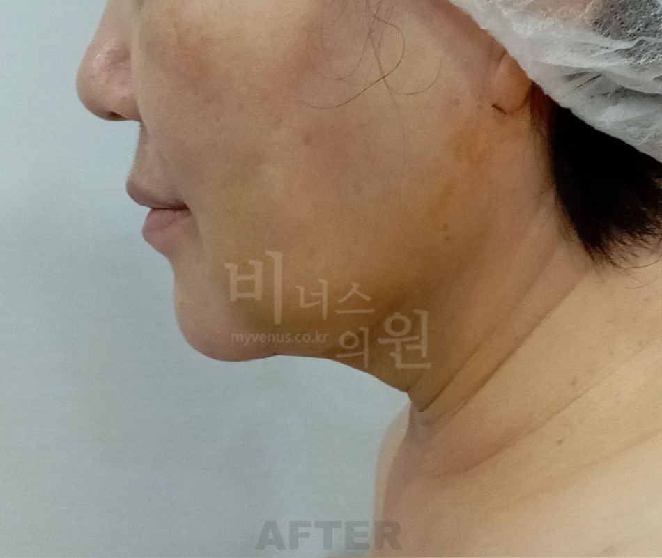 이중턱·턱 지방흡입 수술 후 측면 비너스의원