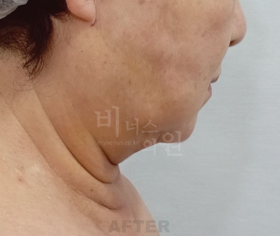 이중턱 지방흡입 후 옆면 비너스의원
