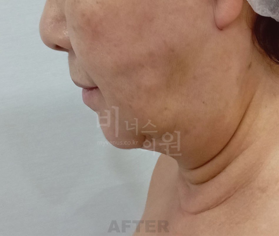 이중턱 지방흡입 후 측면 비너스의원