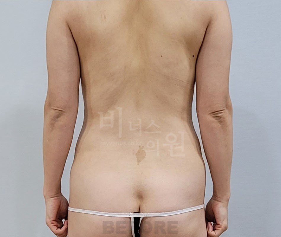 원통형 흉복부 지방흡입 수술 전 후면 비너스의원
