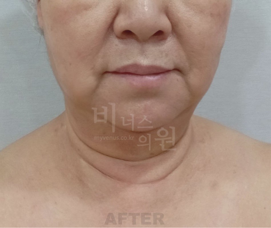 이중턱 지방흡입 후 정면 비너스의원